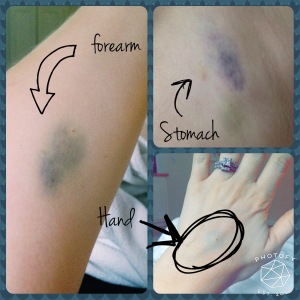 No shame - these bruises mean the protocol is working.... that and the nurses can't get a vein :)